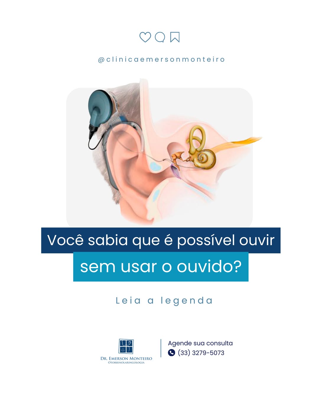 Como funciona o implante coclear